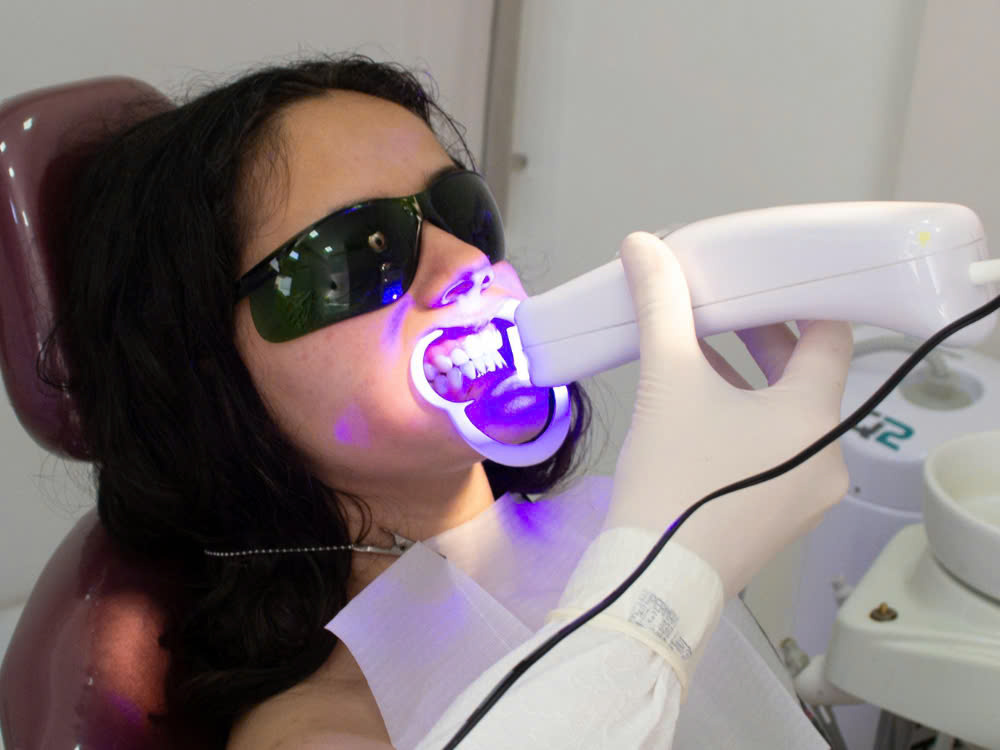 Các loại niềng